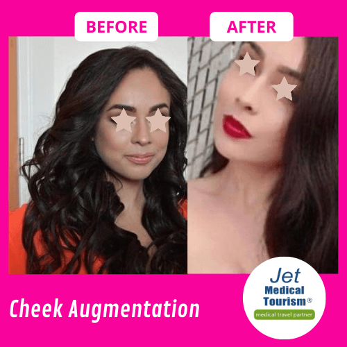 Cheek Augmentation Before and After
