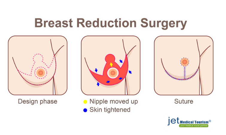 Breast Reduction Near Me