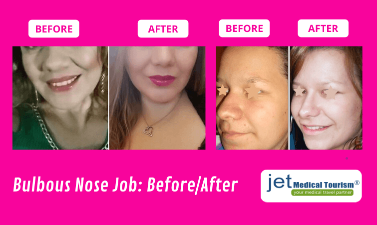 Bulbous Nose Job Before and After