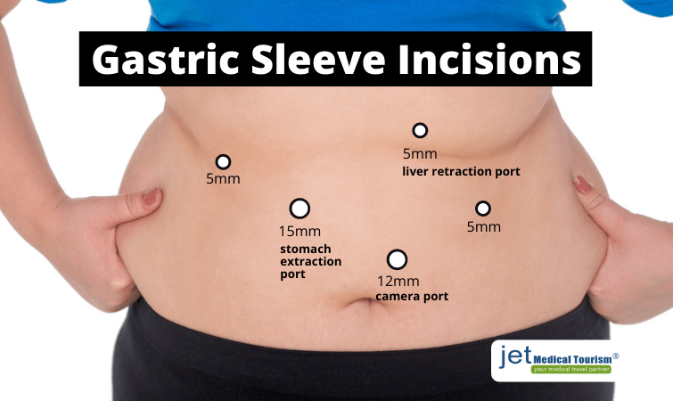 gastric sleeve incisions