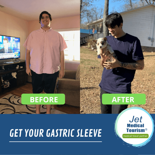 Gastric sleeve before and after male