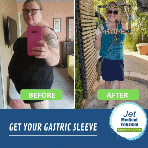 Gastric sleeve before and after female