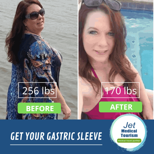 Gastric Sleeve Before and After Female