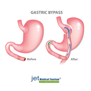 Gastric Bypass Surgery in Mexico