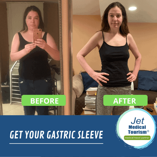 Gastric sleeve before and after pic
