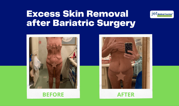 Excess Skin Removal after Bariatric Surgery