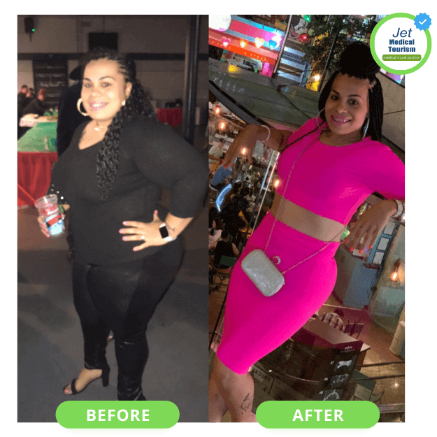 Mexico Bariatric Surgery Before and After Transformation Picture