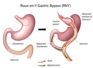 gastric bypass surgery in Mexico