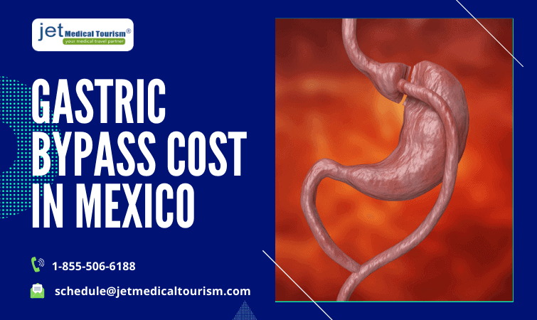 Gastric Bypass Cost in Mexico