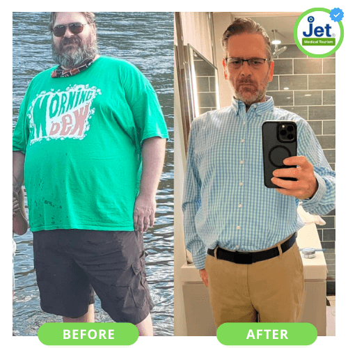 Gastric Sleeve Before and After Male Pictures