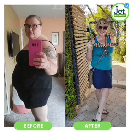 Gastric sleeve before and after pic