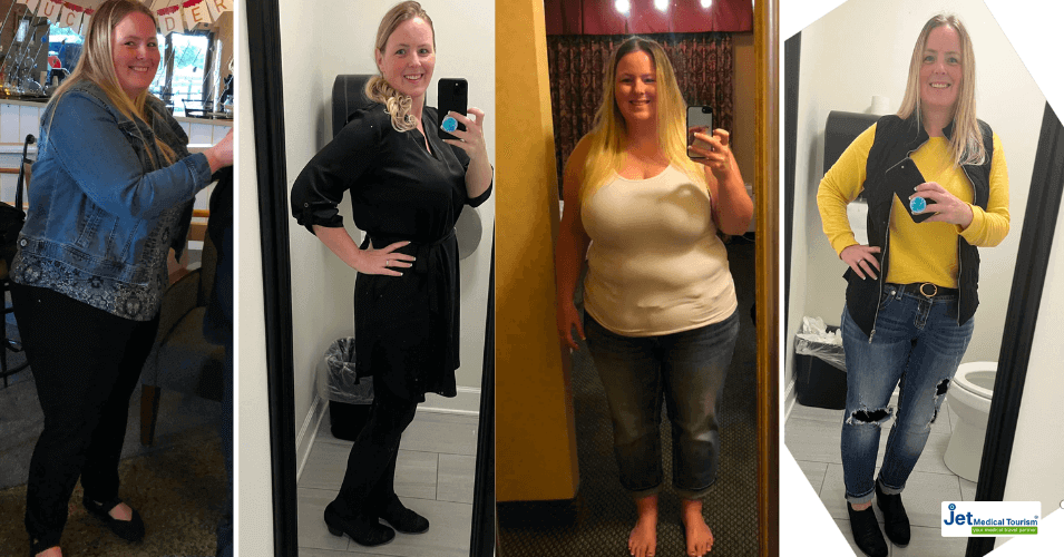 Gastric Sleeve Before and After Success Story- Tedda