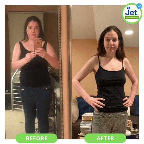 Gastric Sleeve Weight Loss Surgery Before and After photo