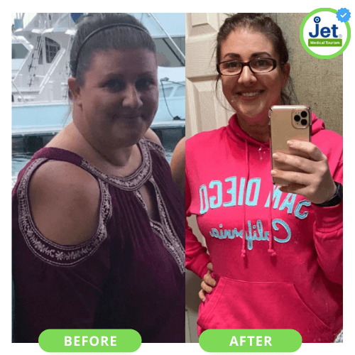 Christry's Gastric Sleeve Before and After Photo