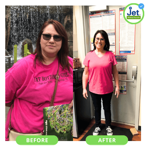 mexico gastric sleeve before and after pics