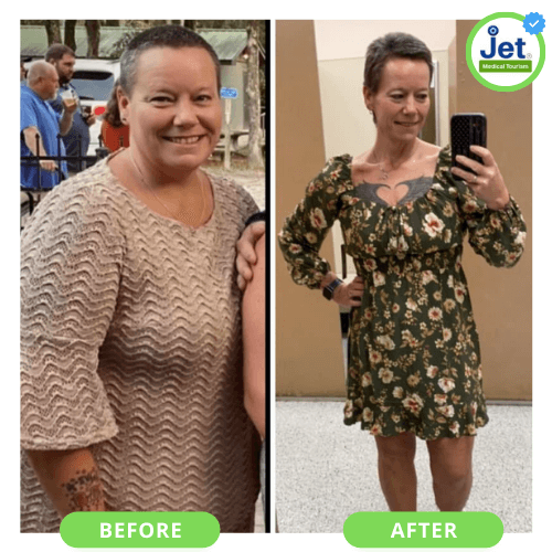 Mexico Gastric Sleeve Before and After Transformation Pic