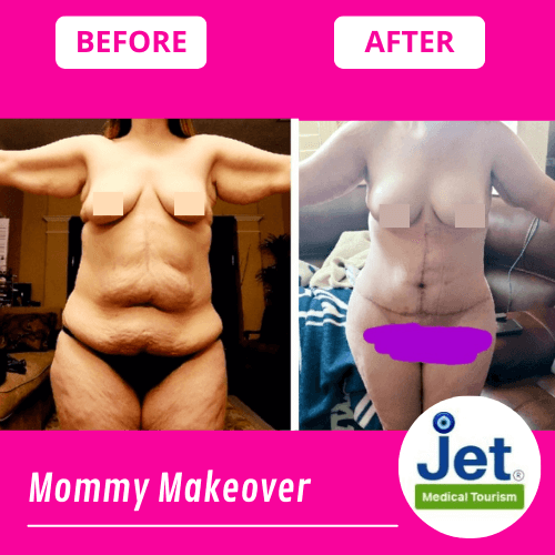 Mommy Makeover Before and After Pic