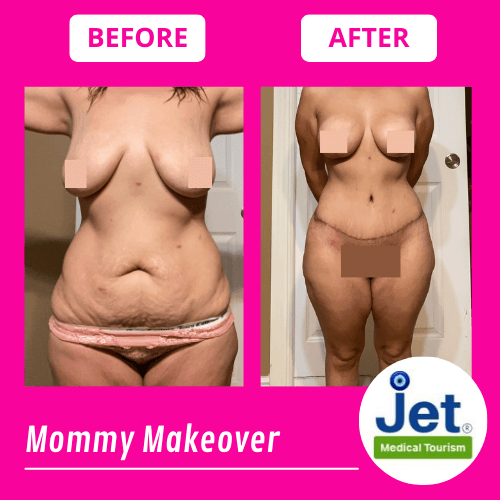 Mommy Makeover Before and After Photo