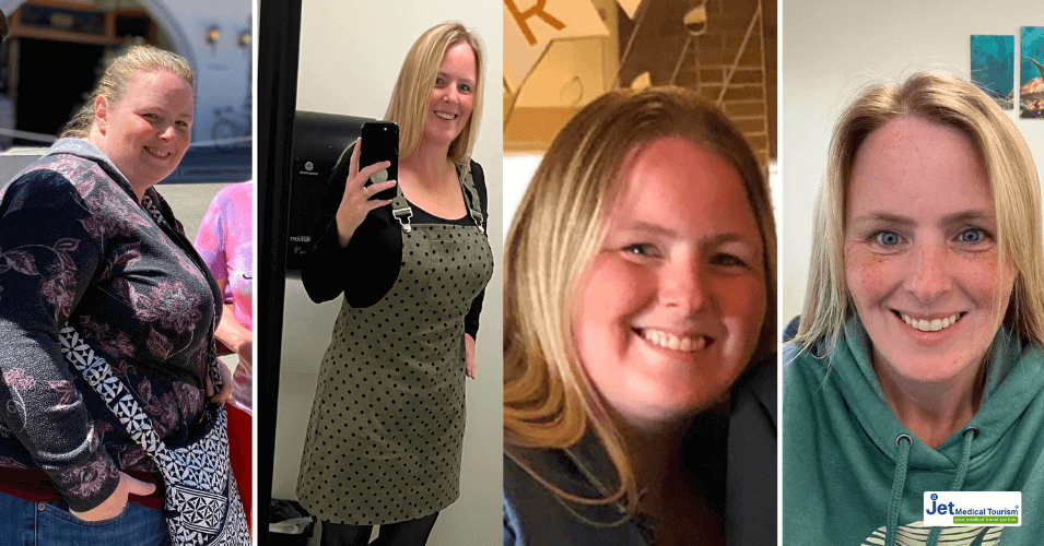 Tedda's Gastric Sleeve Before and After Pictures