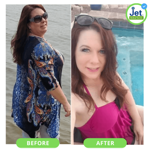 Christina's Gastric Sleeve Before and After photo