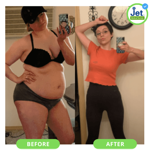bariatric surgery before and after pics