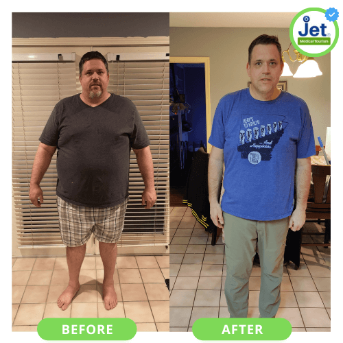 Bariatric surgery before and after male