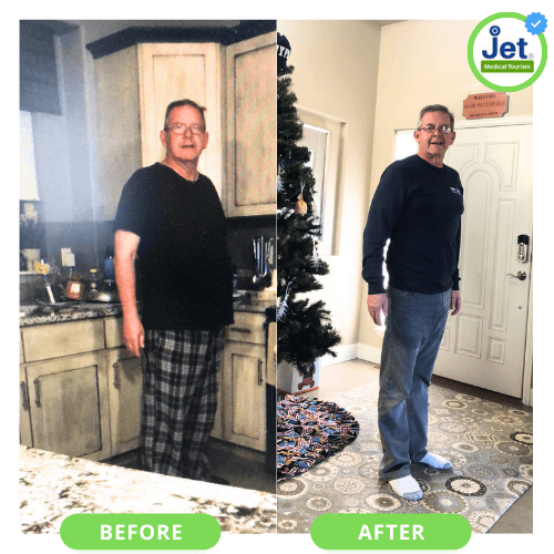 Bariatric surgery before and after pictures male
