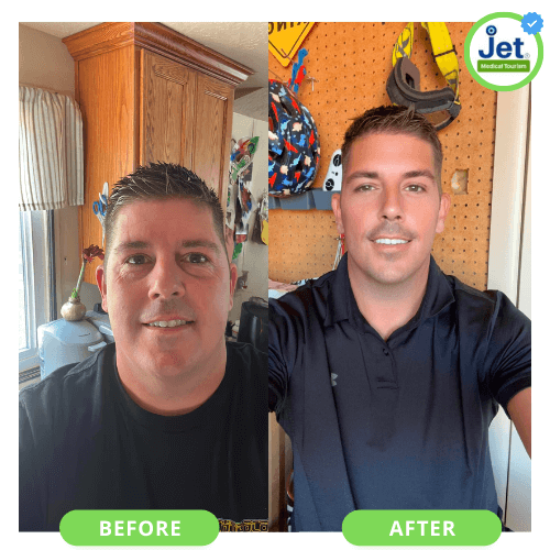 gastric sleeve before and after male pics