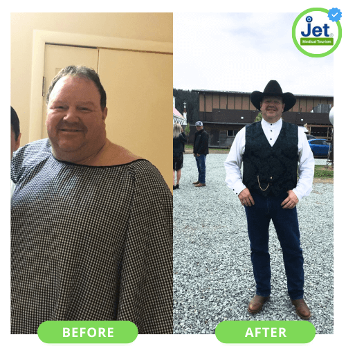 gastric sleeve before and after men