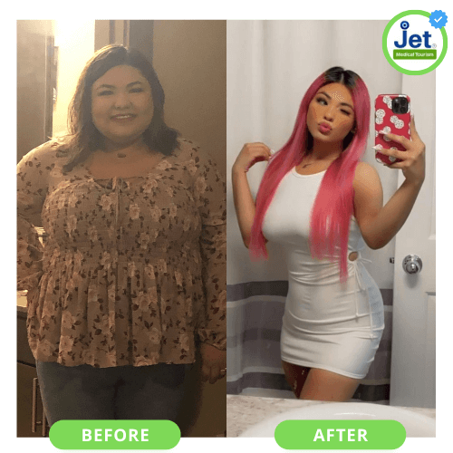 Gastric sleeve before and after photos