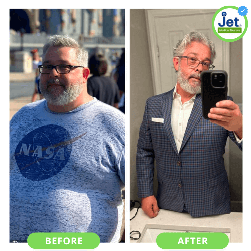 gastric sleeve before and after pic male