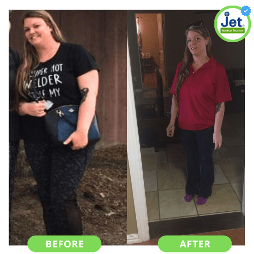 Gastric sleeve before and after transformation