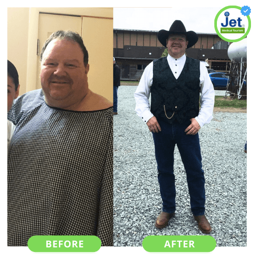 Gastric sleeve in Mexico: Before and After
