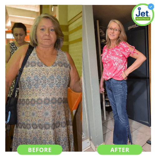 Gastric Sleeve Before and After Transformation
