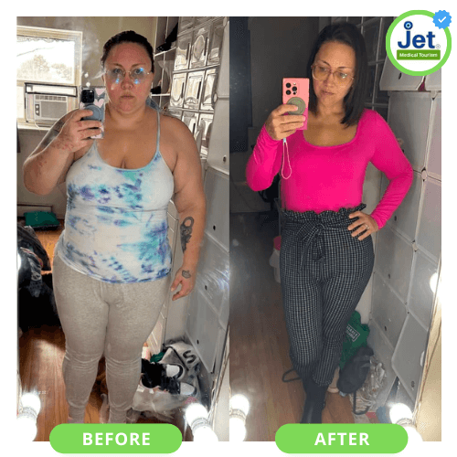 Mexico Gastric Sleeve Before and After