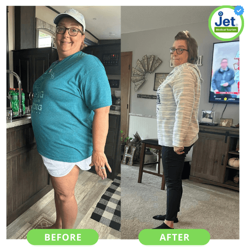 Tijuana Bariatric Surgery Before and After