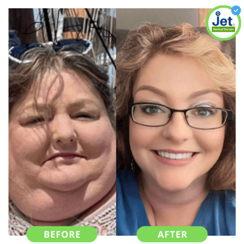Female Before and After Gastric Sleeve Tijuana Cost