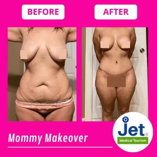 Mommy Makeover Before and After