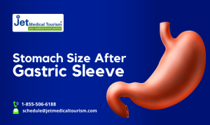 Stomach Size After Gastric Sleeve Surgery