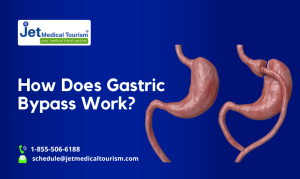 How Does Gastric Bypass Work