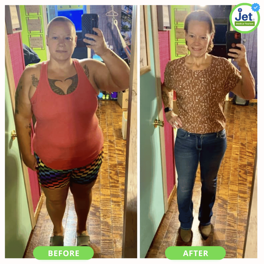 Weight Loss Surgery Center Tijuana MX: Before and After Photo