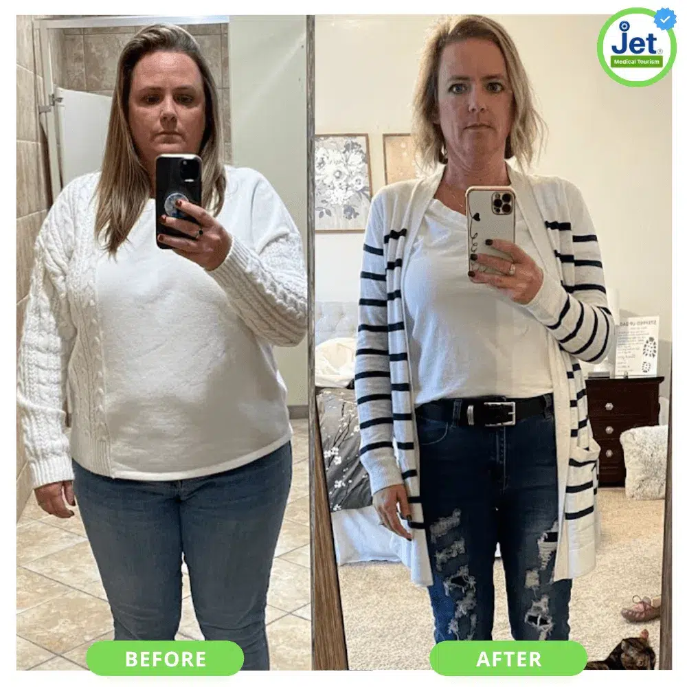 Before and after photos of a female patient showing significant weight loss following gastric sleeve surgery.