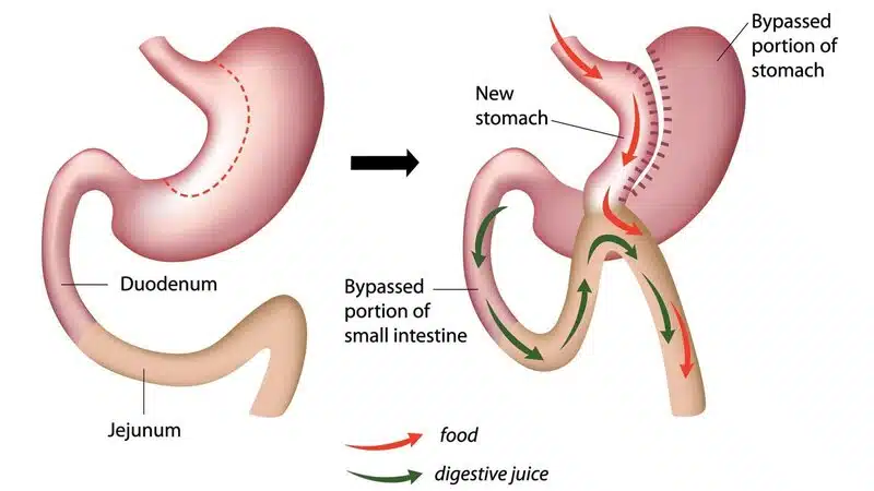 Illustration of mini gastric bypass showing a small stomach pouch and rerouted intestine, highlighting reduced food intake and calorie absorption.