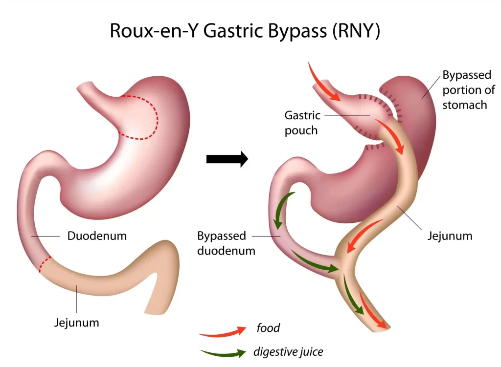 Gastric Bypass Surgery Diagram - Illustration showing the stomach being divided and connected to the small intestine to reduce stomach size and alter food absorption for weight loss.