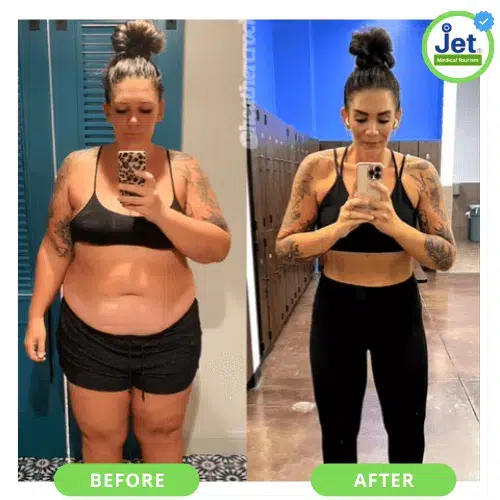 Before and after photos of a female patient showing significant weight loss results following weight loss surgery.