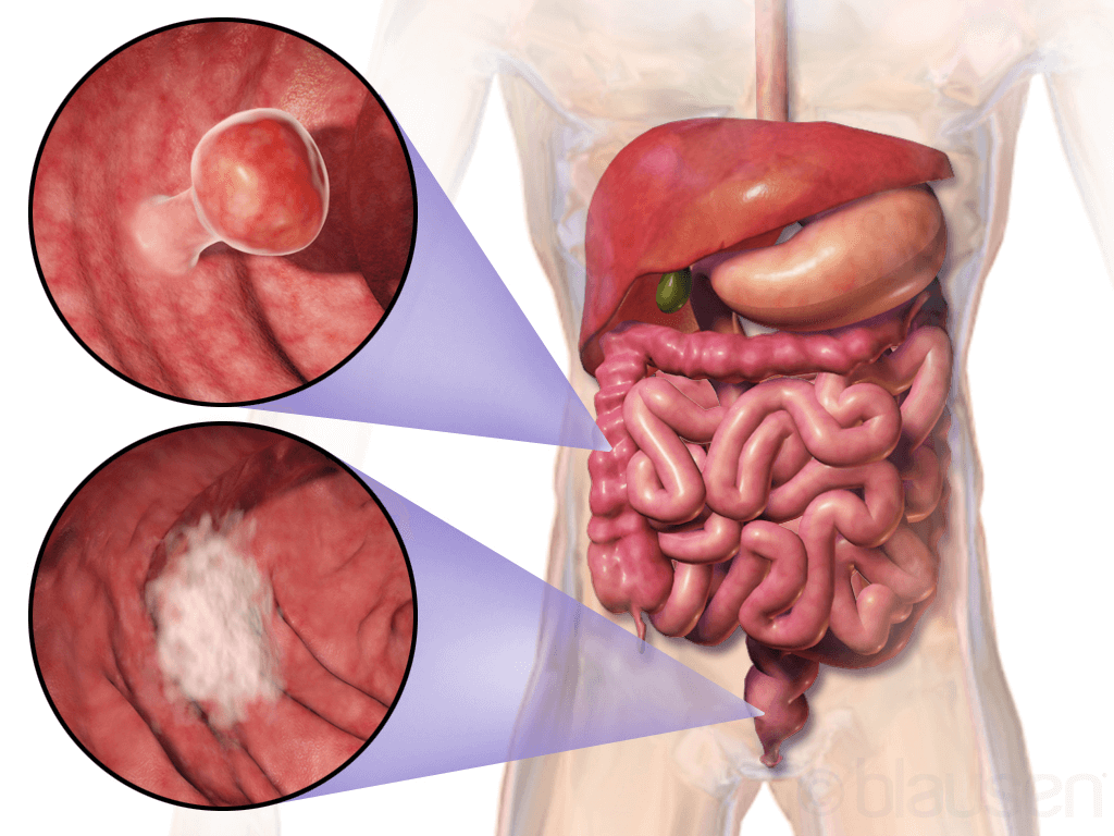 Diagram illustrating the colon cancer screening process, emphasizing the importance of early detection and prevention.