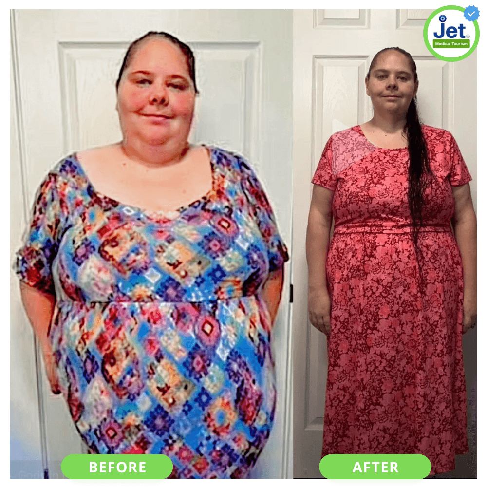 Before and after photos of a female patient showing significant weight loss results following mini gastric bypass surgery.