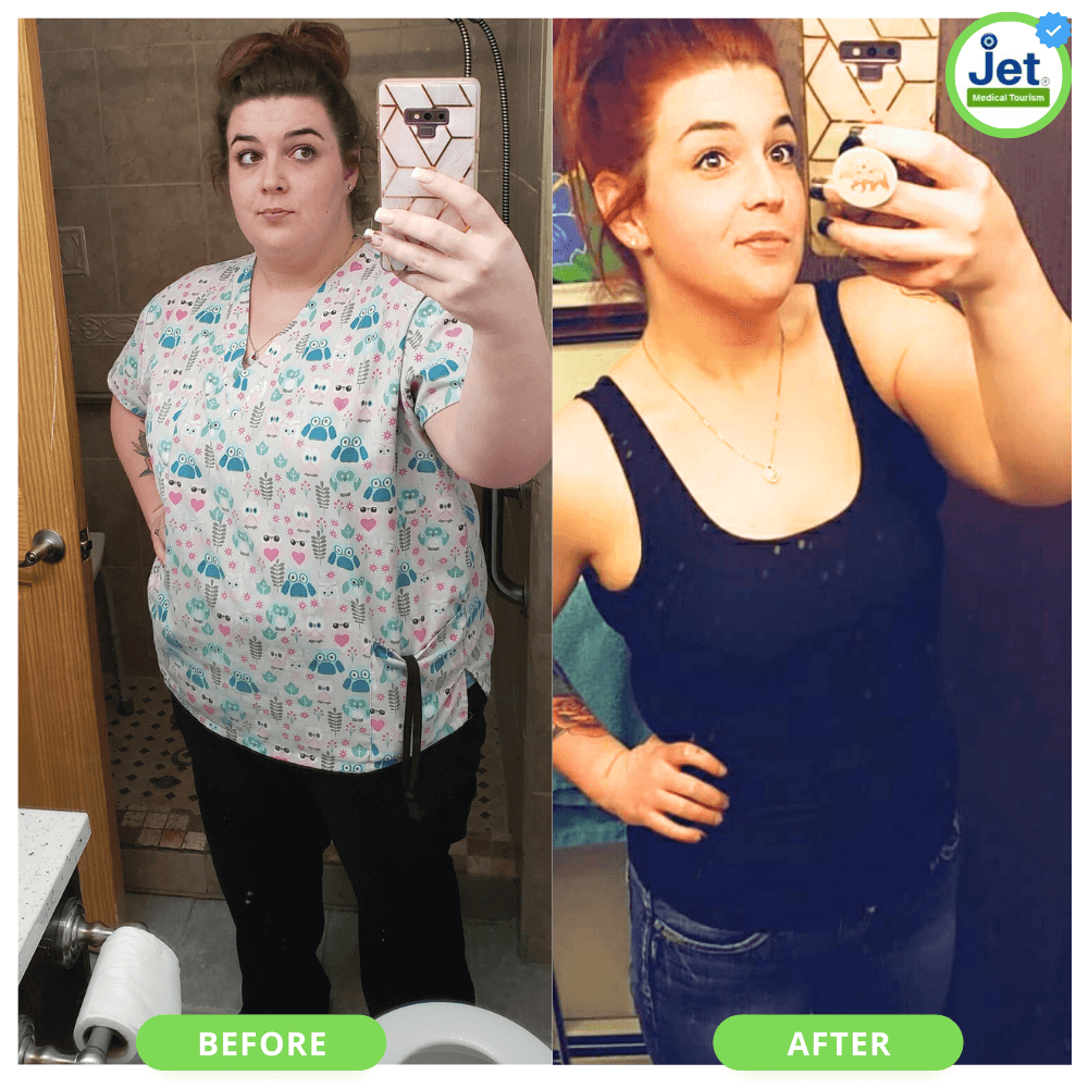 Before and after transformation of a patient following mini gastric bypass surgery, highlighting significant weight loss and enhanced well-being.